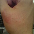 Remède : Contre l’eczéma Voici quelques astuces qui pourront aider à estomper l’eczéma. Bain de flocons d’avoine contre les irritations et les démangeaisons Utiliser les plantes suivantes par voie interne pour leurs propriétés anti-inflammatoires...