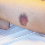 contusion